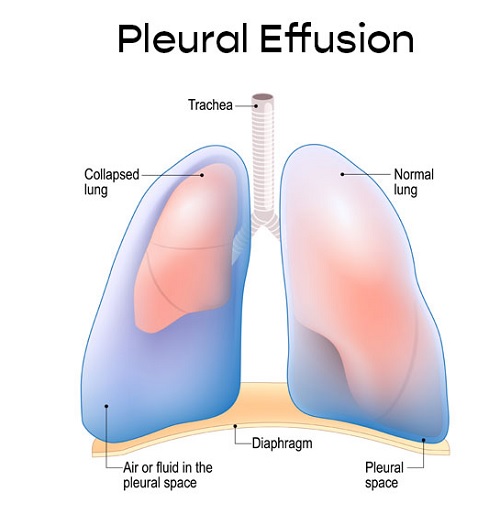 TRANSUDATIVE PLEURAL EFFUSION, EXUDATIVE PLEURAL EFFUSION, CAUSES , FLUID CHARACTERISTICS, SYMPTOMS, DIAGNOSIS AND TREATMENT OF TRANSUDATIVE PLEURAL EFFUSION AND EXUDATIVE EFFUSION, CAUSES OF HYDROTHORAX, SYMPTOMS OF HYDROTHORAX, PROGNOSIS AND COMPLICATIONS OF HYDROTHORAX TRANSUDATIVE PLEURAL EFFUSION, EXUDATIVE PLEURAL EFFUSION, CAUSES , FLUID CHARACTERISTICS, SYMPTOMS, DIAGNOSIS AND TREATMENT OF TRANSUDATIVE PLEURAL EFFUSION AND EXUDATIVE EFFUSION, CAUSES OF HYDROTHORAX, SYMPTOMS OF HYDROTHORAX, PROGNOSIS AND COMPLICATIONS OF HYDROTHORAX