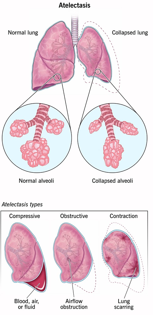 PATHOPHYSIOLOGY OF ATELECTASIS, RISK FACTORS OF ATELECTASIS, MANAGEMENT PRACTICES OF ATELECTASIS, OBSTRUCTIVE ATELECTASIS, COMPRESSIVE ATELECTASIS, ADHESIVE OR RELAXATION ATELECTASIS, RISK FACTORS OF ATELECTASIS, SYMPTOMS, DIAGNOSIS AND TREATMENT OF DIFFERENT TYPES OF ATELECTASIS AND PREVENTION OF ATELECTASIS PATHOPHYSIOLOGY OF ATELECTASIS, RISK FACTORS OF ATELECTASIS, MANAGEMENT PRACTICES OF ATELECTASIS, OBSTRUCTIVE ATELECTASIS, COMPRESSIVE ATELECTASIS, ADHESIVE OR RELAXATION ATELECTASIS, RISK FACTORS OF ATELECTASIS, SYMPTOMS, DIAGNOSIS AND TREATMENT OF DIFFERENT TYPES OF ATELECTASIS AND PREVENTION OF ATELECTASIS