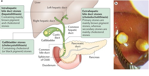 FORMATION, CAUSES AS WELL AS RISK FACTORS, SYMPTOMS, DIAGNOSIS, TREATMENT PREVENTION OF CHOLESTEROL GALL STONES AND CALCIUM BILIRUBINATE GALL STONES FORMATION, CAUSES AS WELL AS RISK FACTORS, SYMPTOMS, DIAGNOSIS, TREATMENT PREVENTION OF CHOLESTEROL GALL STONES AND CALCIUM BILIRUBINATE GALL STONES