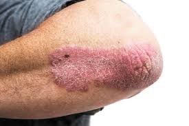 DEALING WITH AUTOIMMUNE PSORIASIS BY HOMOEOPATHIC WAY