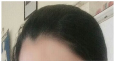 A SAMPLE STUDY OF WIDOWS PEAK A GENETIC TRAIT AT SOLAPUR MAHARASHTRA INDIA