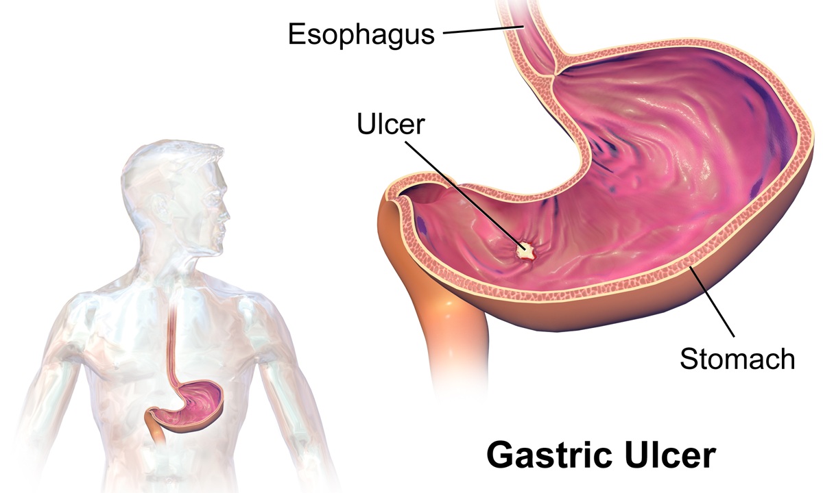 ANTIULCER ACTIVITY BY RESTRAINT COLD WATER INDUCED  ULCERATION IN ANIMAL MODEL OF KAPARDIKA BHASMA  PREPARED BY FOUR DIFFERENT METHODS OF SHODHAN.